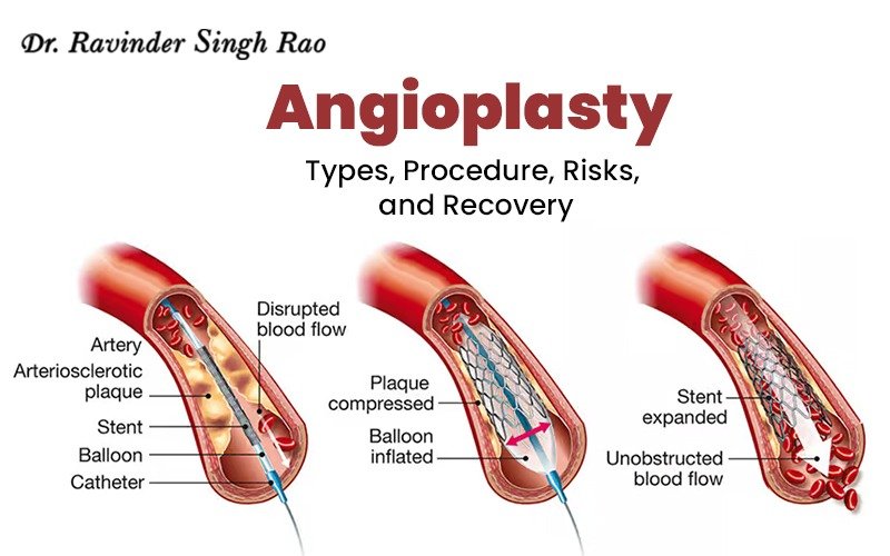 What is Angioplasty: Types, Procedure, Risks, and Recovery